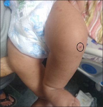BCGosis with erythema nodosum in a child with chronic granulomatous disease: An atypical presentation